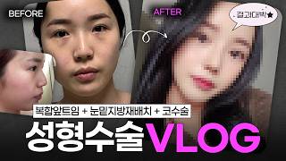 코성형+앞트임+눈밑지방재배치 1년 후기