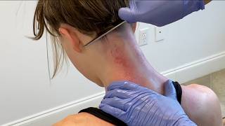 Scraping and CRACKING Away Years of Neck Pain (Gua Sha Therapy)