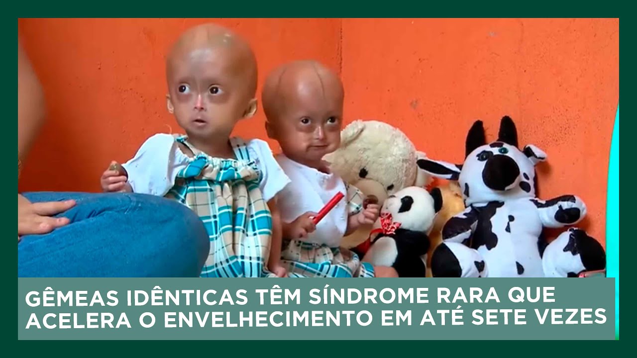 Gêmeas idênticas têm síndrome rara que acelera o envelhecimento em até sete vezes | Dom Espetacular