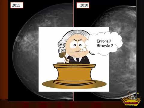 11 Lesioni benigne, borderline e maligne: il follow up. Gian Marco Giuseppetti