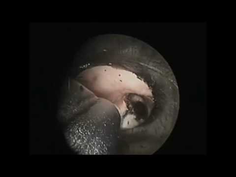 Limax® 120 – Bronchoscopy (4 cases)