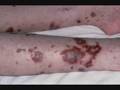 Meningitis - YouTube