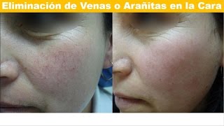 Telangiectasias o venas en la Cara: Tecnología Laser para Eliminar las arañas vasculares en Bogotá