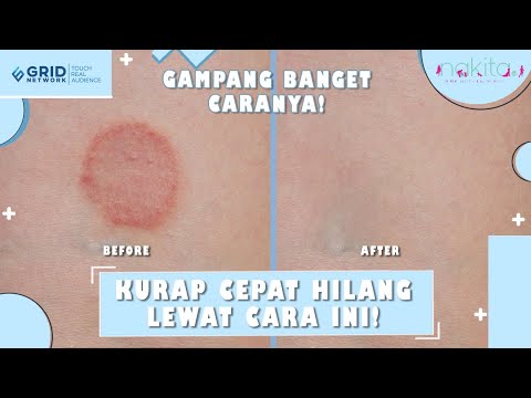 Catat! Ini Cara Menghilangkan Kurap Secara Alami!