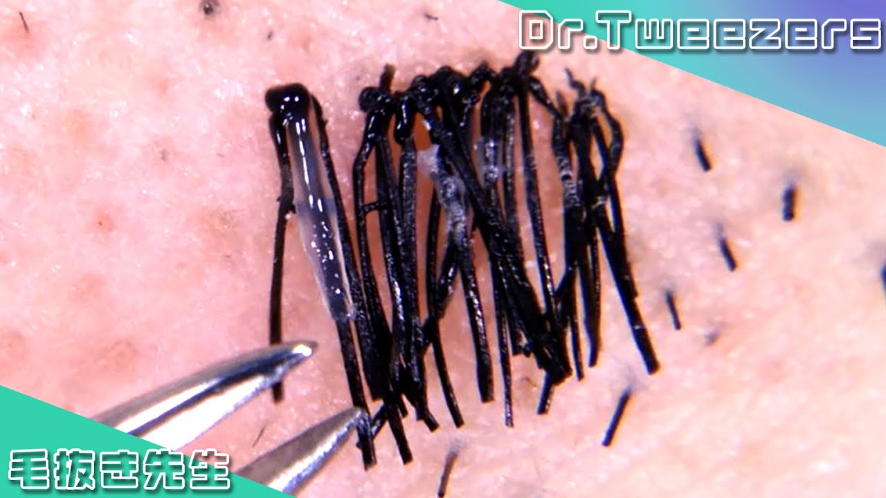 It's time to harvest 毛抜き先生の角栓や毛根