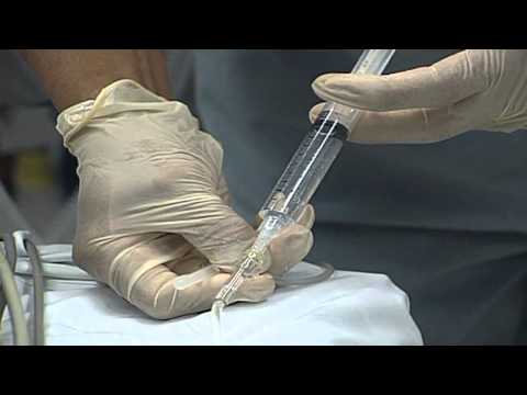 Human papillomavirus and smear test