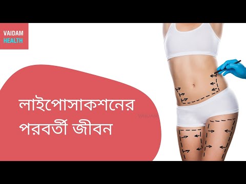 লাইপোসাকশনের পরবর্তী জীবন