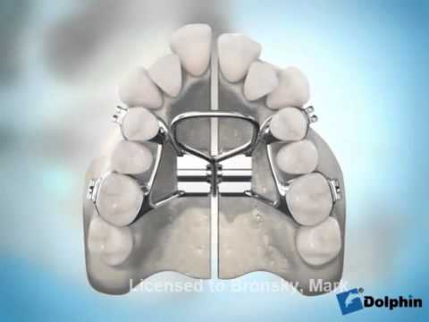 Espansione chirurgica del palato (SARPE)