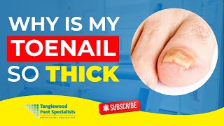Why Is My Toenail So Thick?