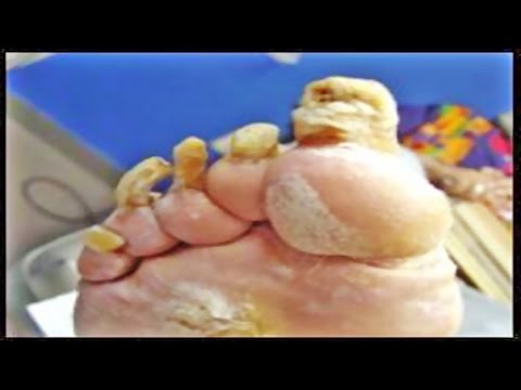 Gamot para sa paggamot ng halamang-singaw sa isda Kaysa sa mabilis na dalhin ang halamang-singaw sa kuko