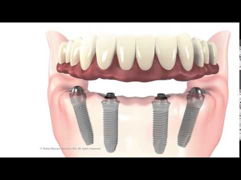 All on 4 ugradnja zubnih implantata Dr. Tatjana Knego