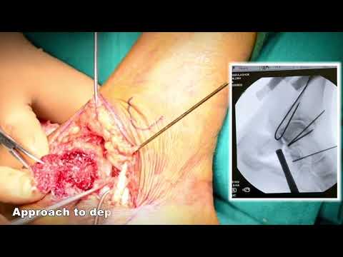 Calcaneal Fracture Fixation by Lateral Extensile approach