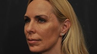 preview picture of video 'Juvederm Voluma Cheek Filler Demo by Dr. Craig Jonov, The Gallery of Cosmetic Surgery - Seattle'