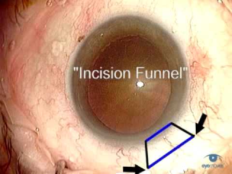 Incision Construction For Phacoemulsification