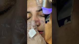 Download lagu What does a Hydra facial do? - Hydrafacial Step By Step Procedure mp3
