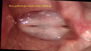 Mucus accumulation, Postnasal drip and the human voice
