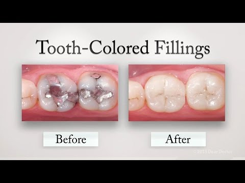 download lagu mp3 mp4 Tooth Colored Restoration, download lagu Tooth Colored Restoration gratis, unduh video klip Tooth Colored Restoration