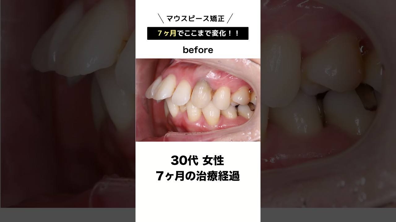 ワイヤーではなくマウスピース矯正したい方必見！#インビザライン #歯列矯正 #さいとう矯正歯科
