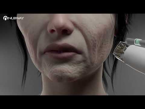 Vacuum Fractional RF microderma-thumb-1