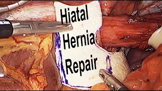 Hiatal Hernia Repair with Actual Surgical Footage & Animation