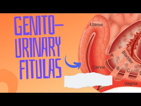 GENITO-URINARY FISTULAS #neetpg #neetpg2024 #neetpgnotes #gynaecology