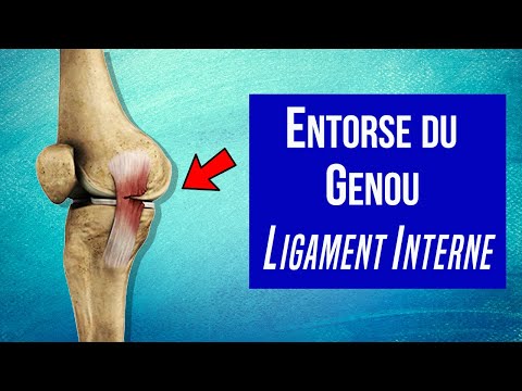 Soigner l'entorse du ligament interne du genou : Les traitements