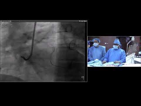PCI of single coronary artery. All 3 branches arising from separate ostium at right coronary sinus