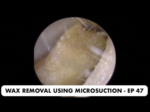 EAR WAX REMOVAL USING MICROSUCTION - EP 47
