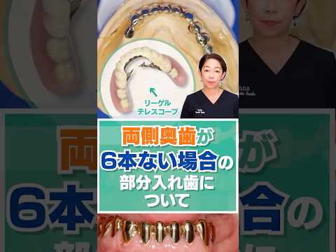 両側奥歯が6本ない場合の部分入れ歯について