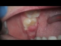 what's this sore gum on wisdom tooth - pericoronitis