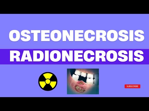 Osteonecrosis y Osteoradionecrosis