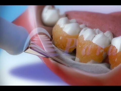 牙周炎及其对健康的影响 ©