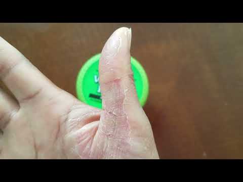 Healing Dyshidrotic Eczema Skin After Flare-up from Chemicals with O'Keeffe's Working Hands Cream