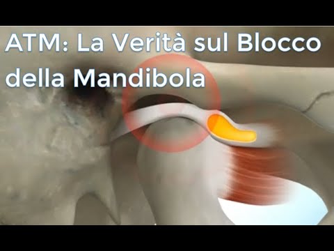 La Verità sul Blocco della Mandibola: Scopri le Cause e Come Risolverlo!