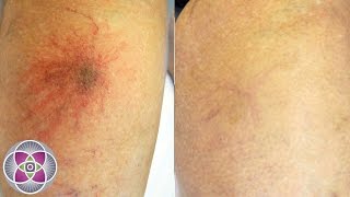 Laser Spider Vein Treatment on the Legs