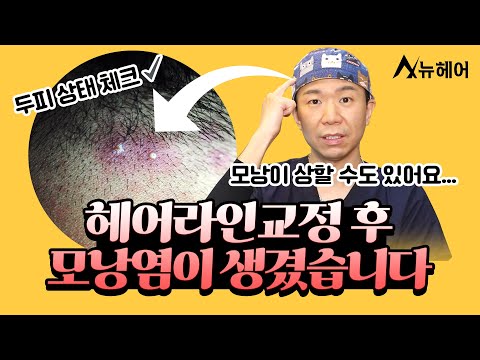 헤어라인 수술 후 생긴 모낭염, 수술 결과에 문제없을까? | 뉴헤어