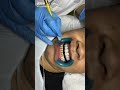 dentist cleaning teeth dental cavity filling dentist dental braces ..