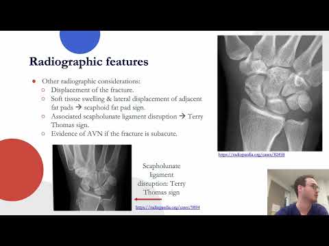 Scaphoid Fractures by Tim Hughes