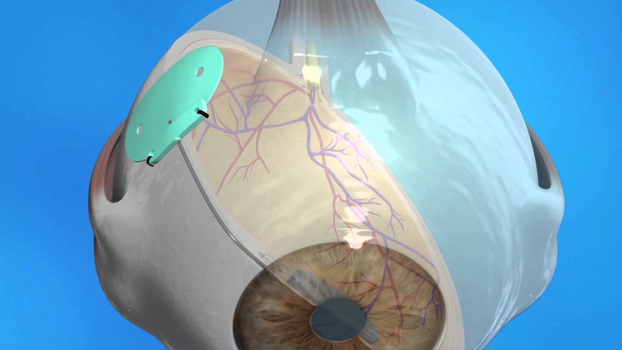 Glaucoma Drainage Implant