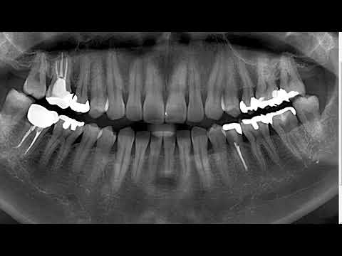 Morita i-Dixel 04 Operation