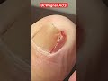 REMOVAL OF A MAMMOTH INGROWN TOENAIL Shorts