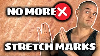 The CURE For Stretch Marks On Steroids!