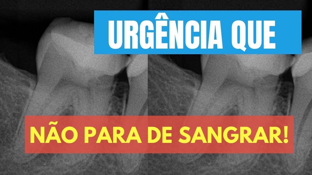 O QUE FAZER EM UMA URGÊNCIA ONDE O CANAL NÃO PARA DE SANGRAR? - QUICK TIP ENDOLOVERS