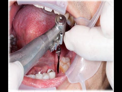 Vídeo de treino de cirurgia de implante dentário: técnicas básicas em implantes dentários