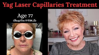 Yag Laser Treatment Face Capillaries 9 5 25 Would I do it again ? #beautytreatment