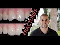 How To Repair A Broken Tooth With Dentist Filling Dentist