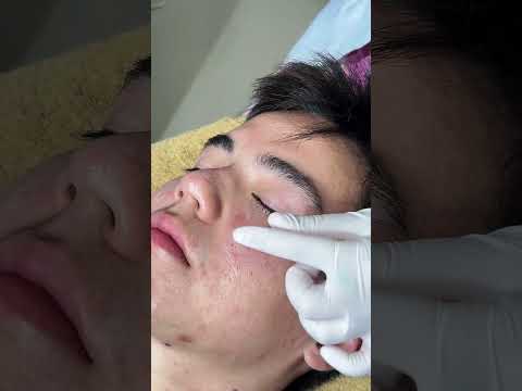 รีวิวหัตถการโปรแกรม CO2 Laser