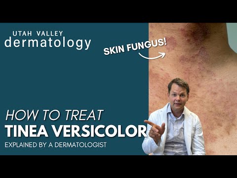 How To Treat Tinea Versicolor | Utah Valley Dermatology