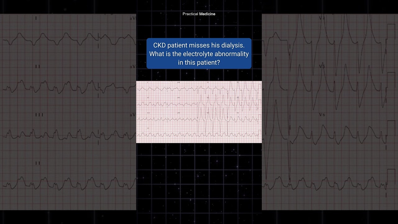 Patient skipped hemodialysis and having lethargy and dizziness. What is ECG diagnosis?