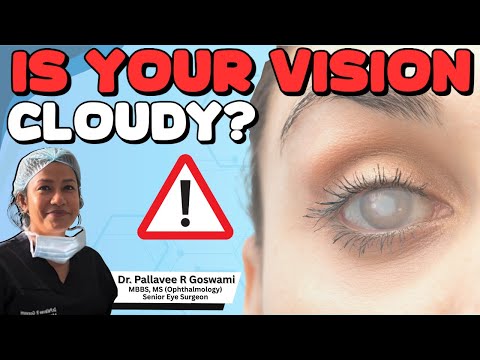 What is Cataract? Causes, Symptoms Explained Simply I Cataract Explained